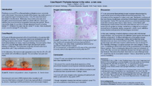 Benign Phyllodes Tumour of Vulva - A rare case (BAGP)